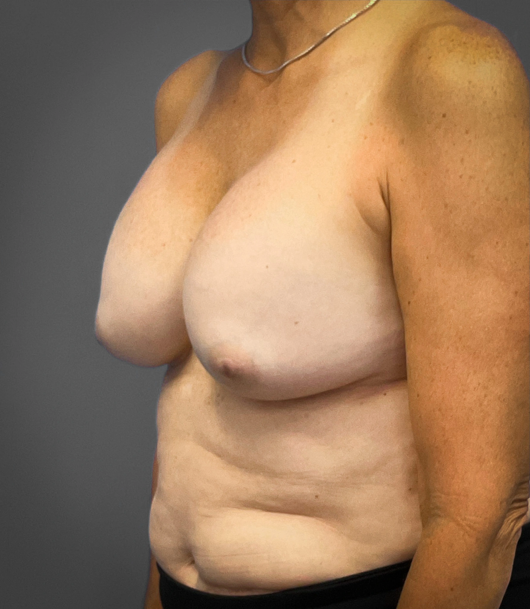 Augmentation-Mastopexy-Case--1213 | Before Breast Augmentation With Lift 5
