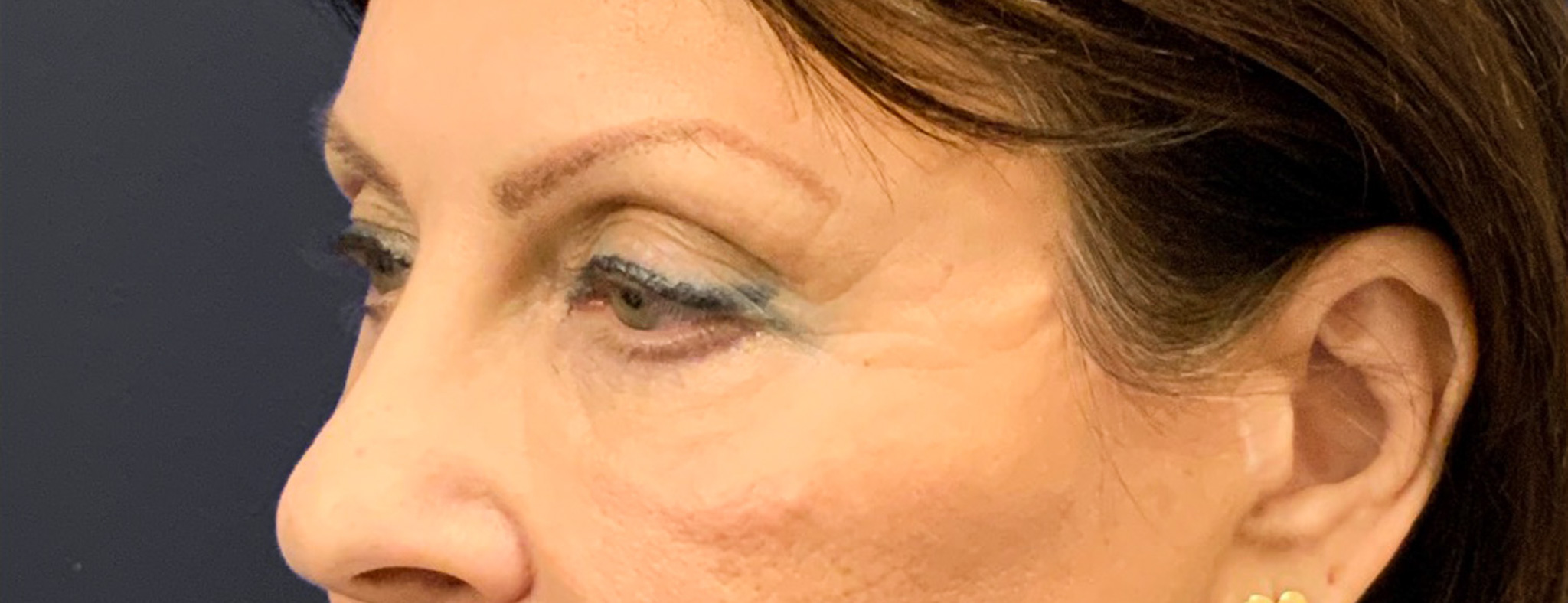 Blepharoplasty-Case--6272 | Before Eyelid Surgery 7