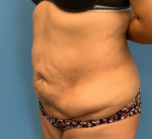 Abdominoplasty-Case--23747 | Before Tummy Tuck 2