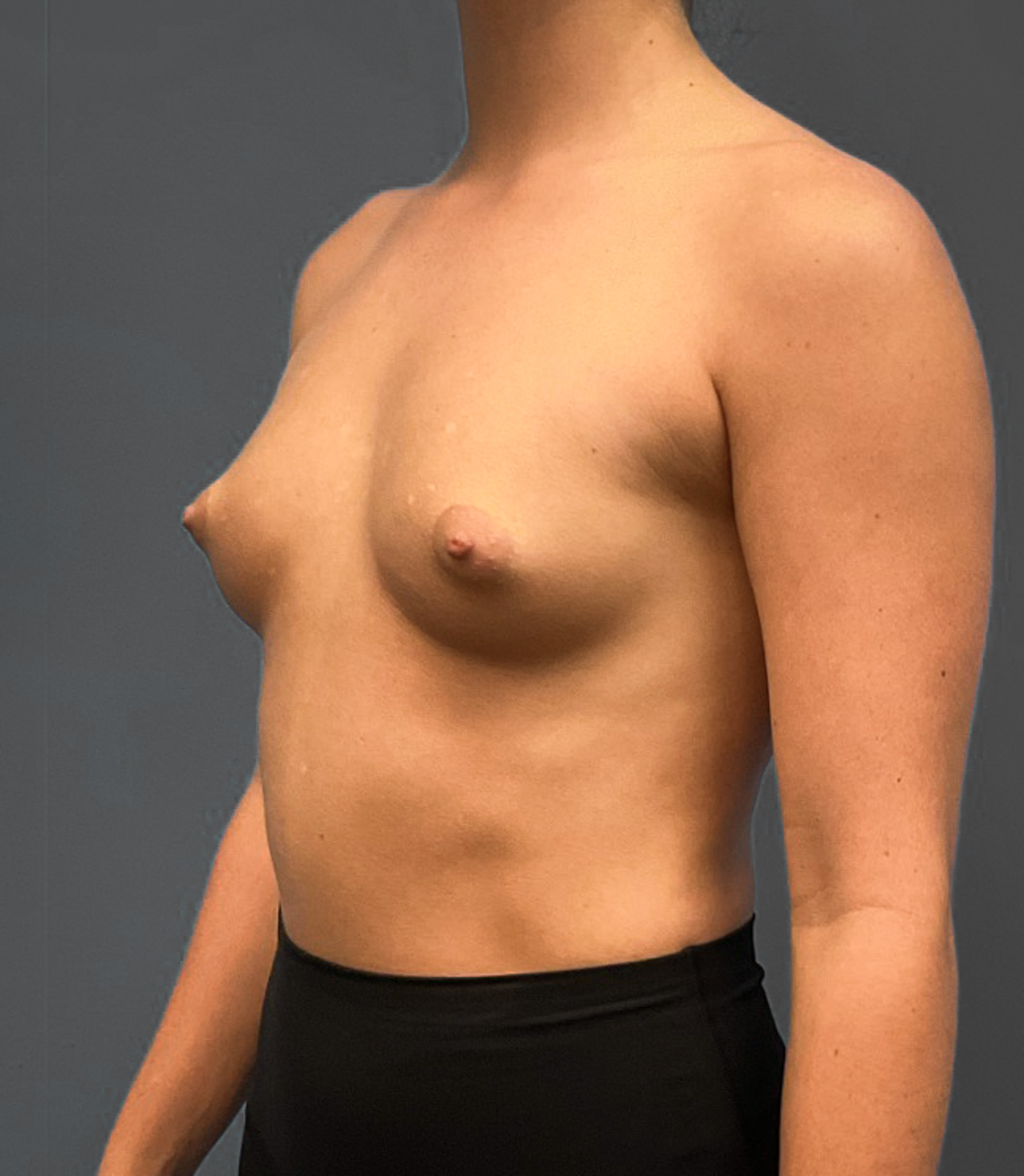 Breast-Augmentation-Case--2384 | Before Breast Augmentation 4