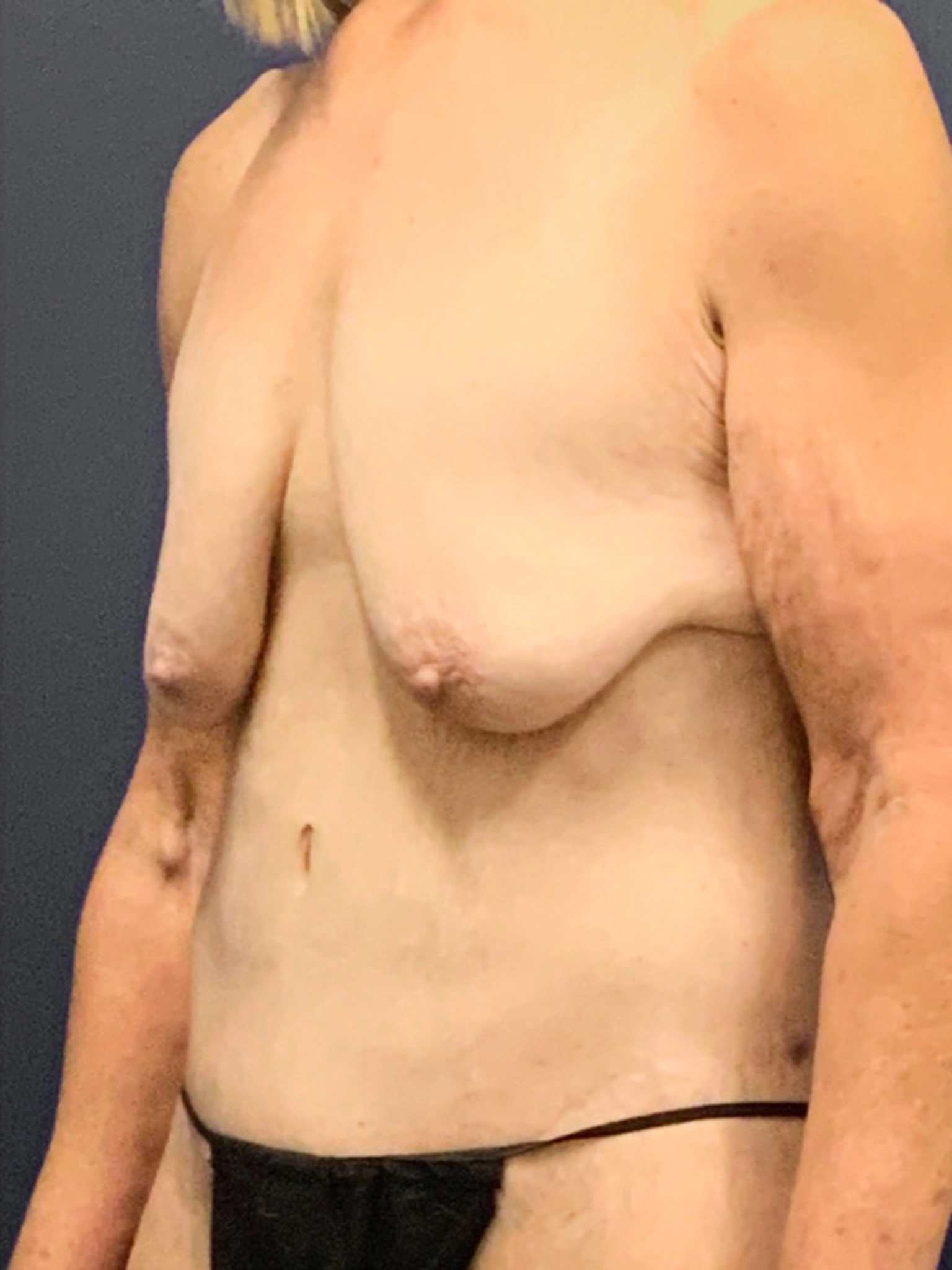 Augmentation-Mastopexy-Case--3055 | Before Breast Augmentation With Lift 4