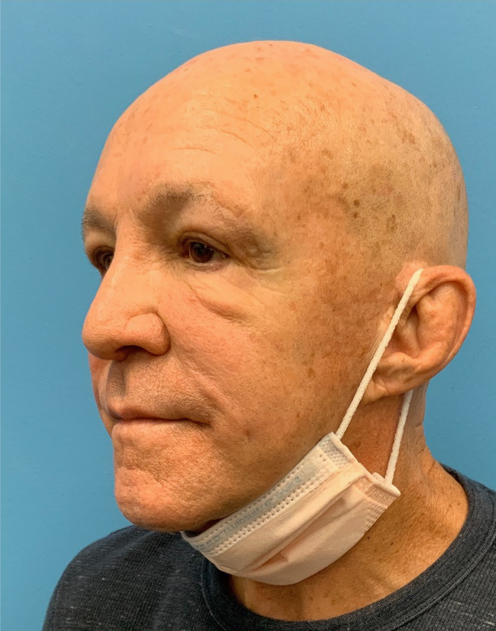 Blepharoplasty-Case--24169 | Before Eyelid Surgery 3