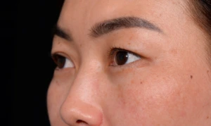 Blepharoplasty-Case--356 | Before Eyelid Surgery 2