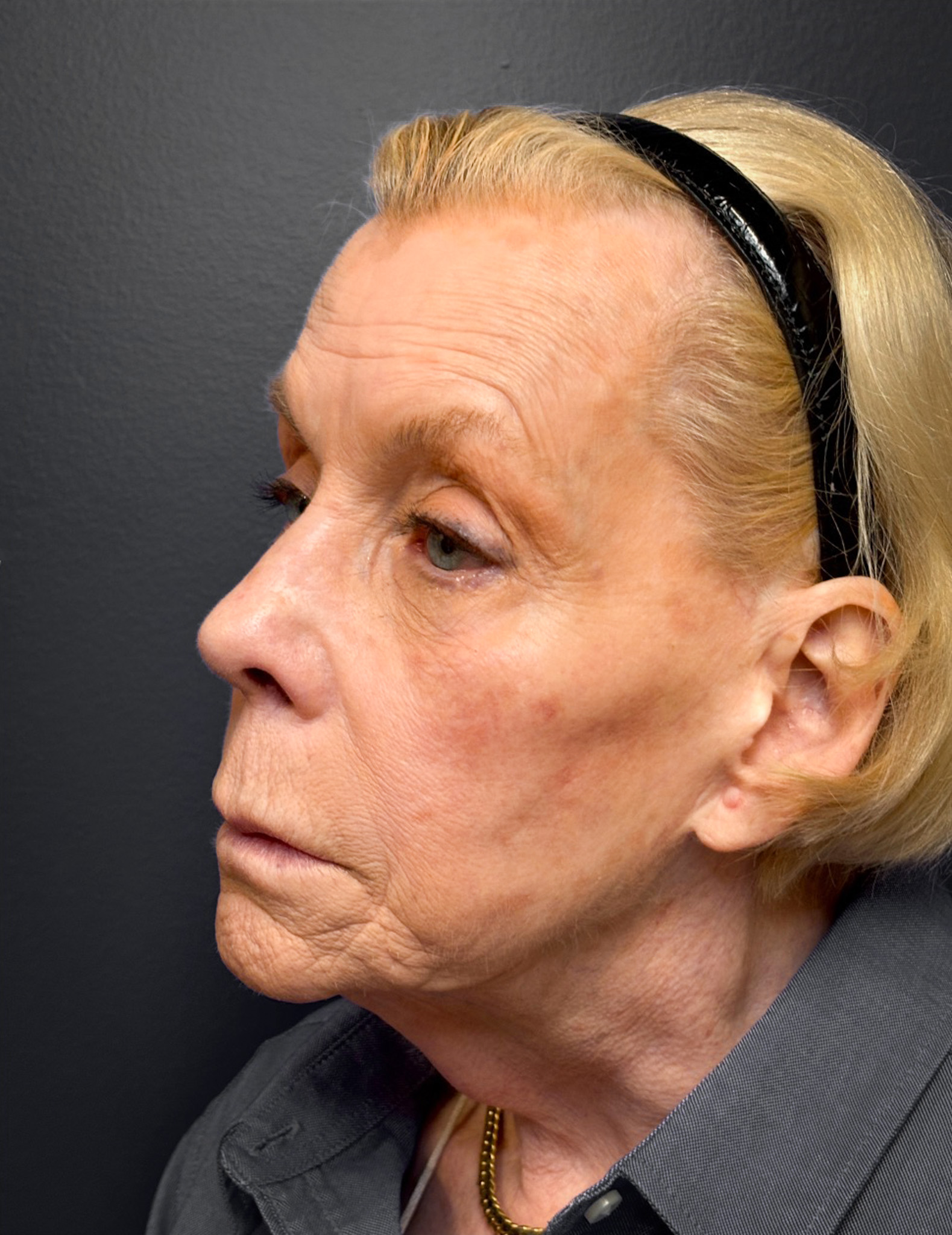 Facelift-Case--7247 | Before Facelift 5