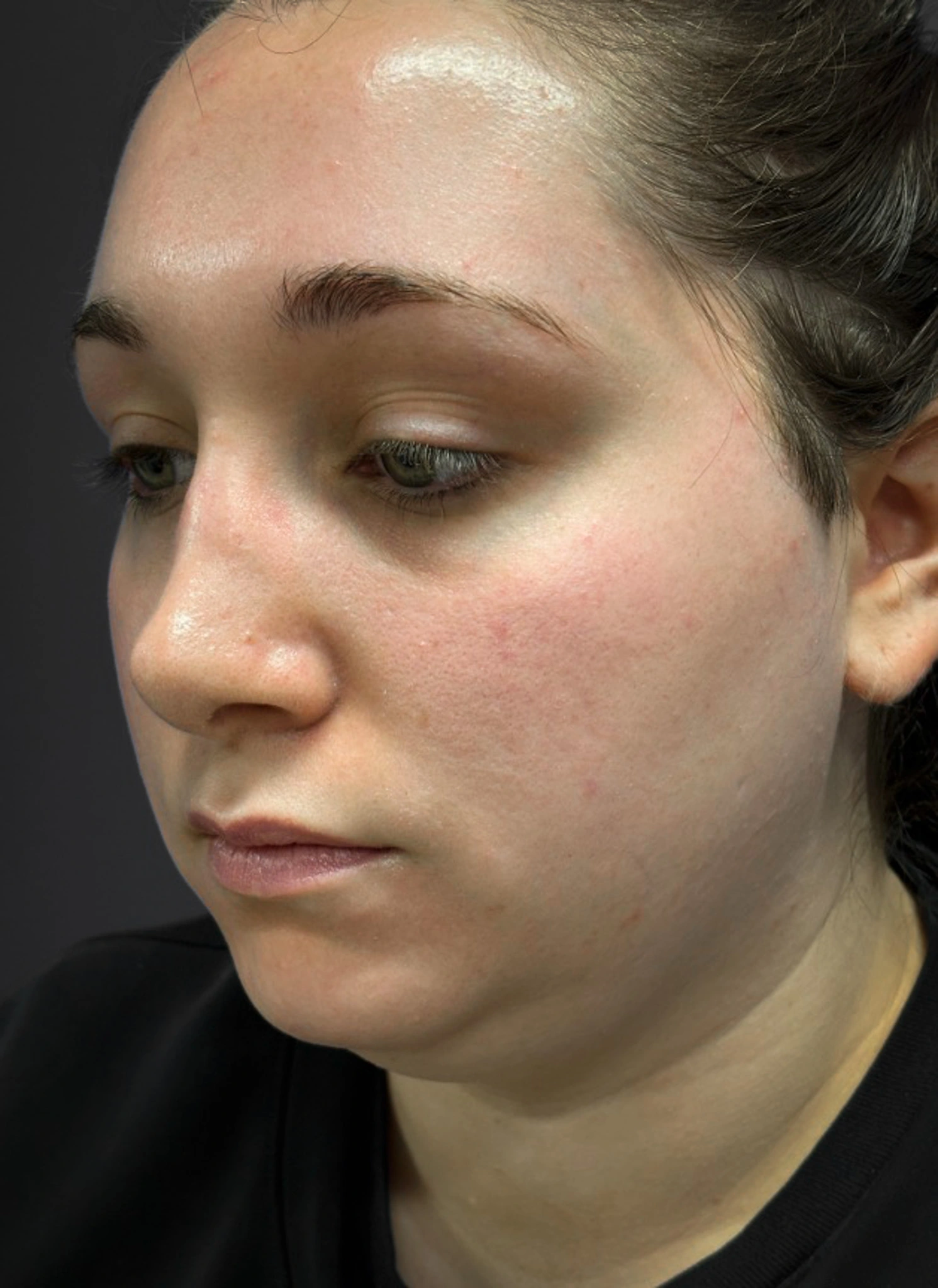 Submental-Liposuction-Case--3439 | Before Submental Liposuction 5