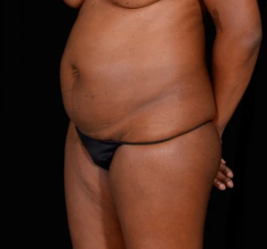 Abdominoplasty-Case--340 | Before Tummy Tuck 2