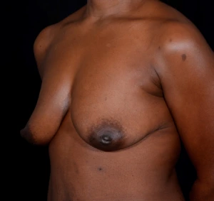 Augmentation-Mastopexy-Case--385 | Before Breast Augmentation With Lift 2