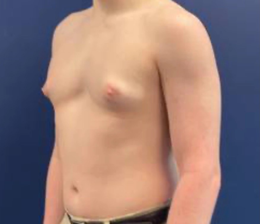 Gynecomastia-Case--214 | Before Gynecomastia / Male Breast Reduction 3