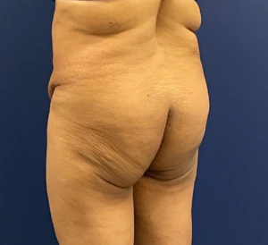 Brazilian-Butt-Lift-Case--215 | Before Brazilian Butt Lift 2