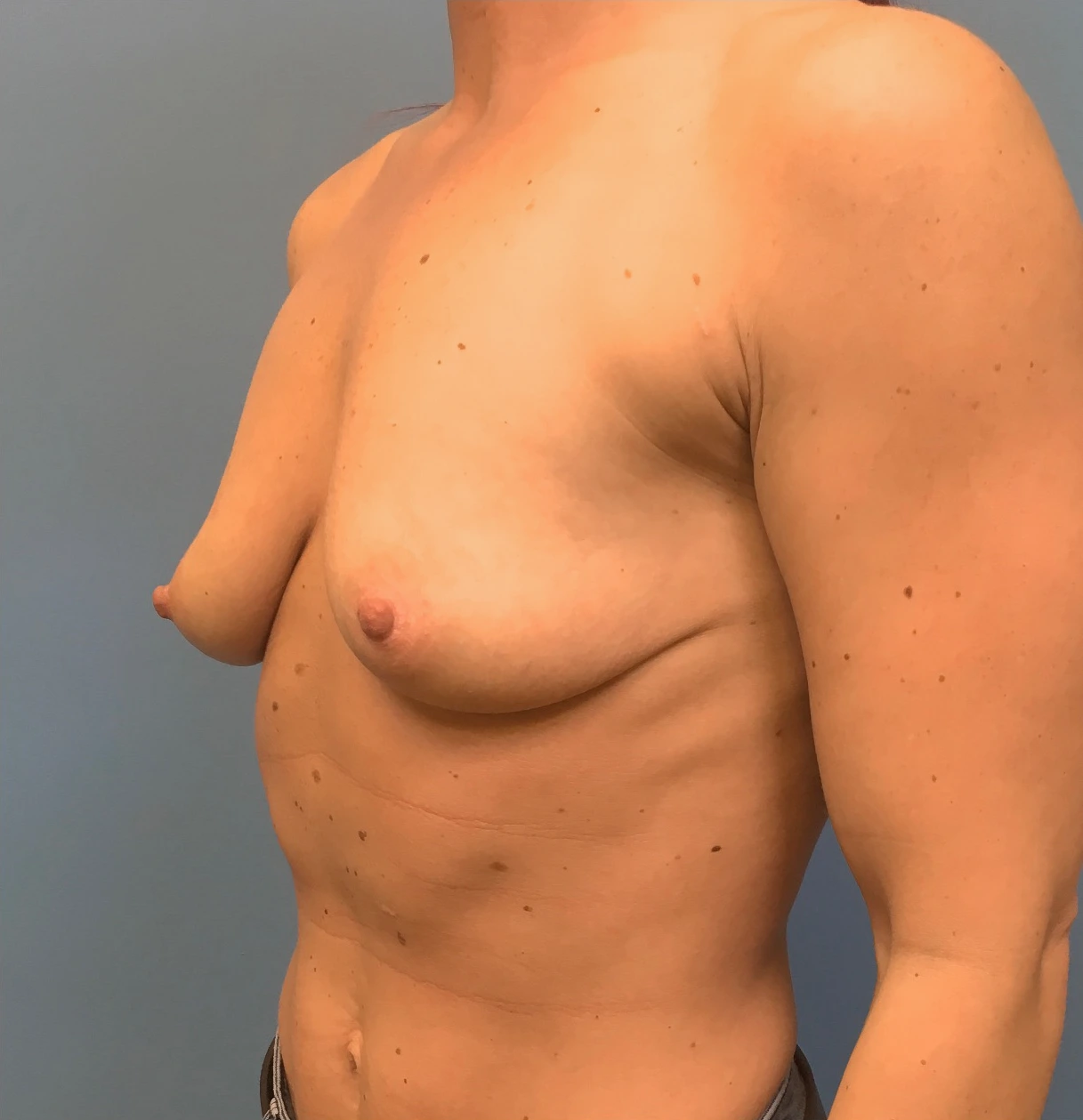 Case--17251 | Before Breast Augmentation 2