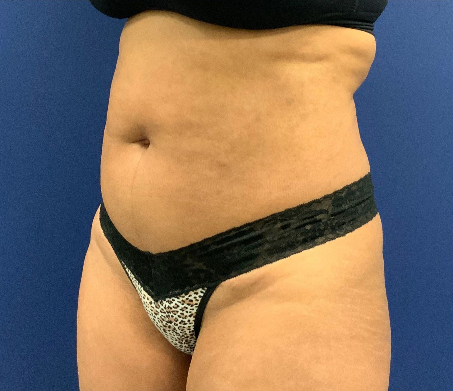 Lipoabdominoplasty-Case--21755 | Before Tummy Tuck 2