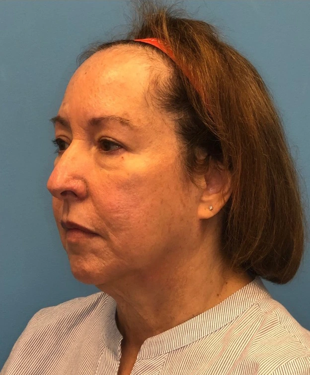 Facelift-Case--21241 | Before Facelift 2