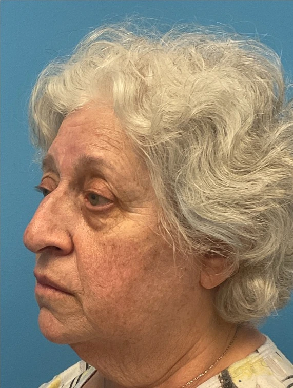 Rhinoplasty-Case--25467 | Before Rhinoplasty 3