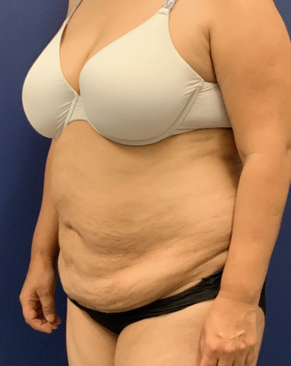 Liposuction-Abdominoplasty-Case--25576 | Before Liposuction 4