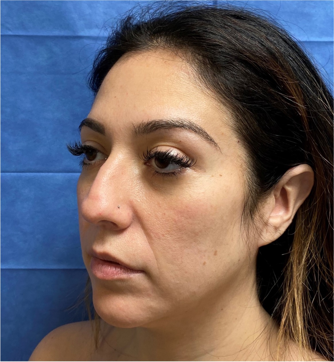 Rhinoplasty-Case--377 | Before Rhinoplasty 1