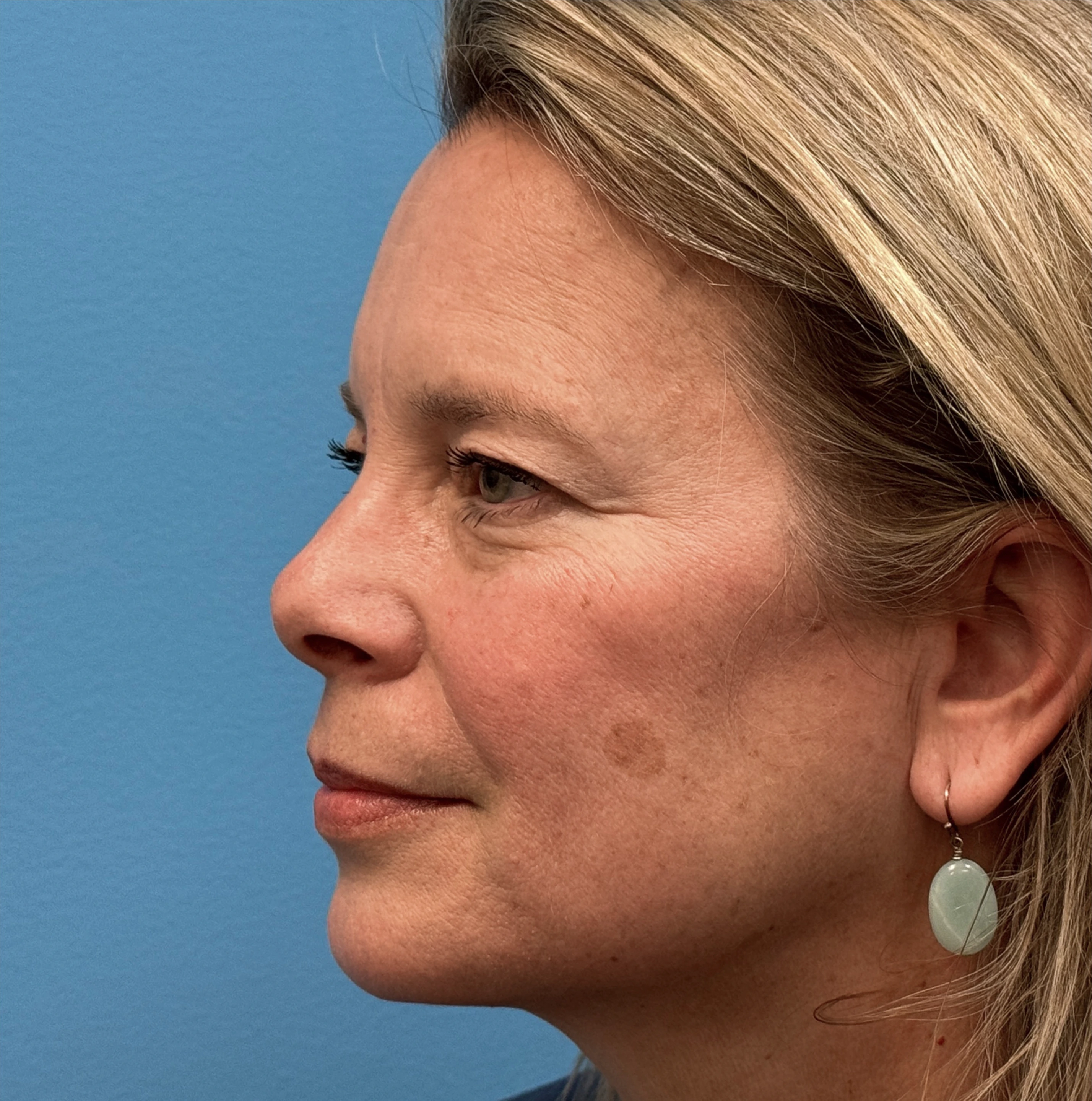 Blepharoplasty-Case--13622 | Before Eyelid Surgery 3