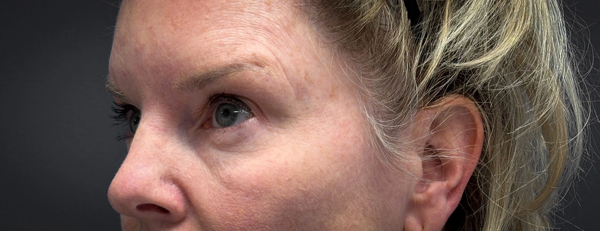 Blepharoplasty-Case--7015 | Before Eyelid Surgery 2