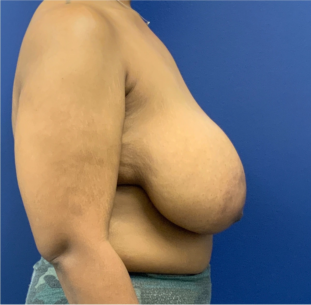 Breast-Reduction-Case--27281 | Before Breast Reduction 5