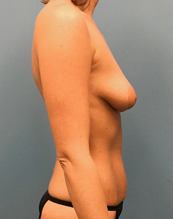 Mommy-Makeover-Case--41 | Before Mommy Makeover 3