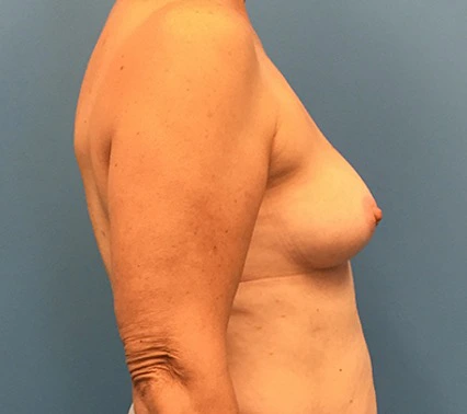 Case--133 | Before Breast Reconstruction 3