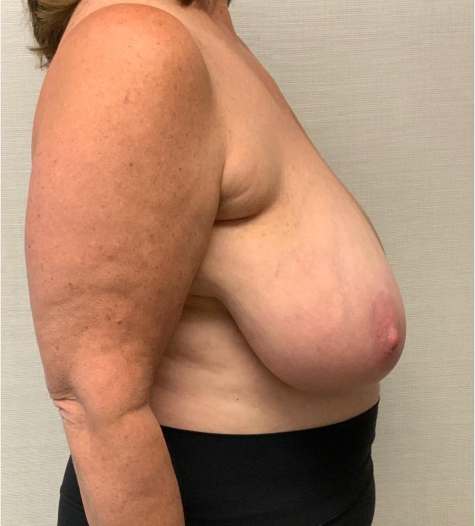 Breast-Reduction-Case--26425 | Before Breast Reduction 3