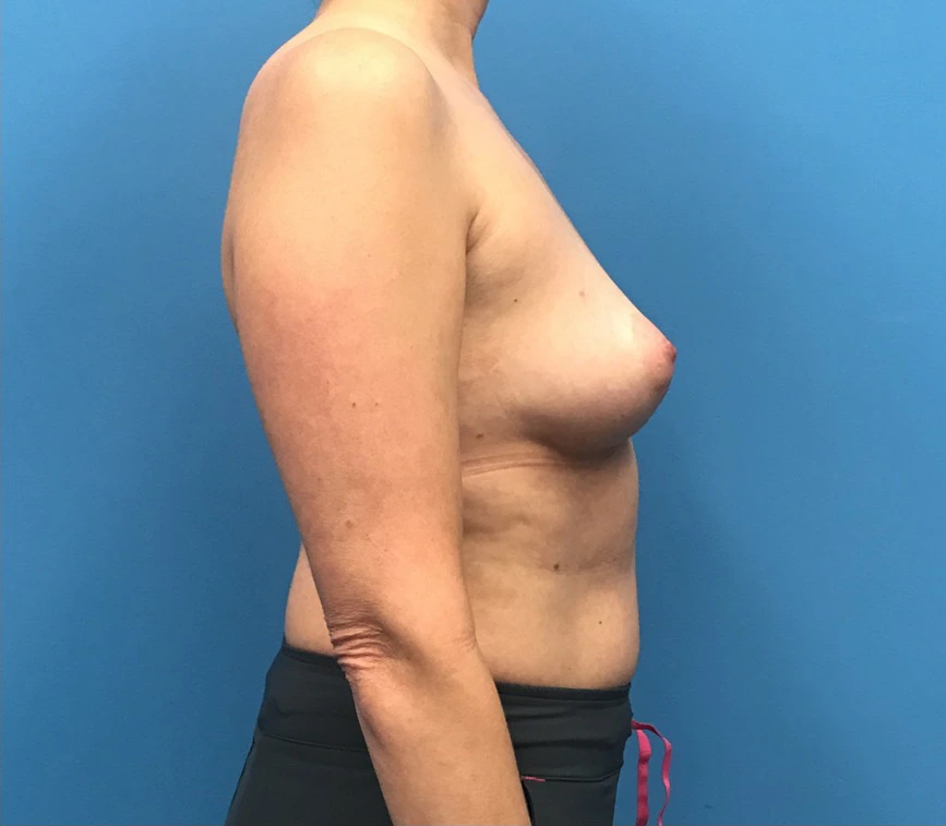 Case--12659 | Before Breast Reconstruction 2