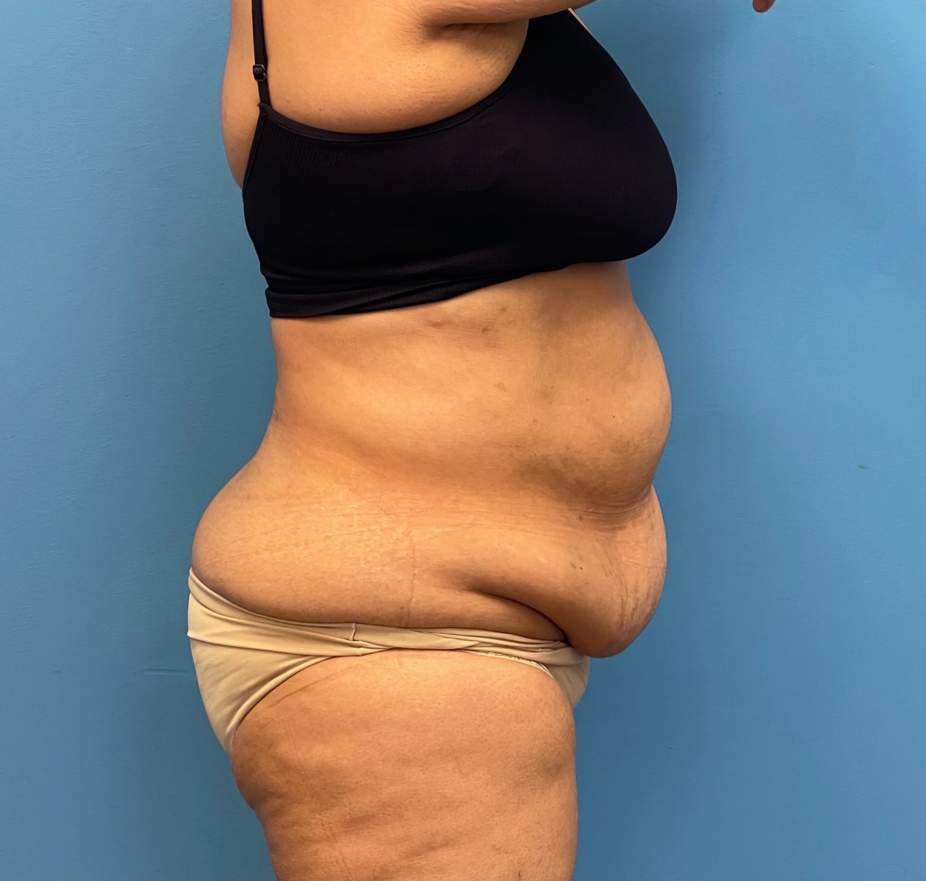 Lipoabdominoplasty-Case--27602 | Before Liposuction 3