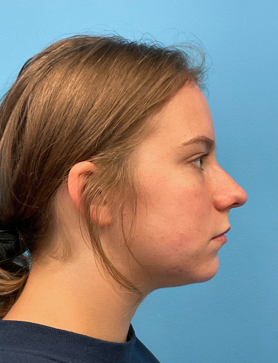 Rhinoplasty-Septoplasty-Case--23611 | Before Rhinoplasty 2