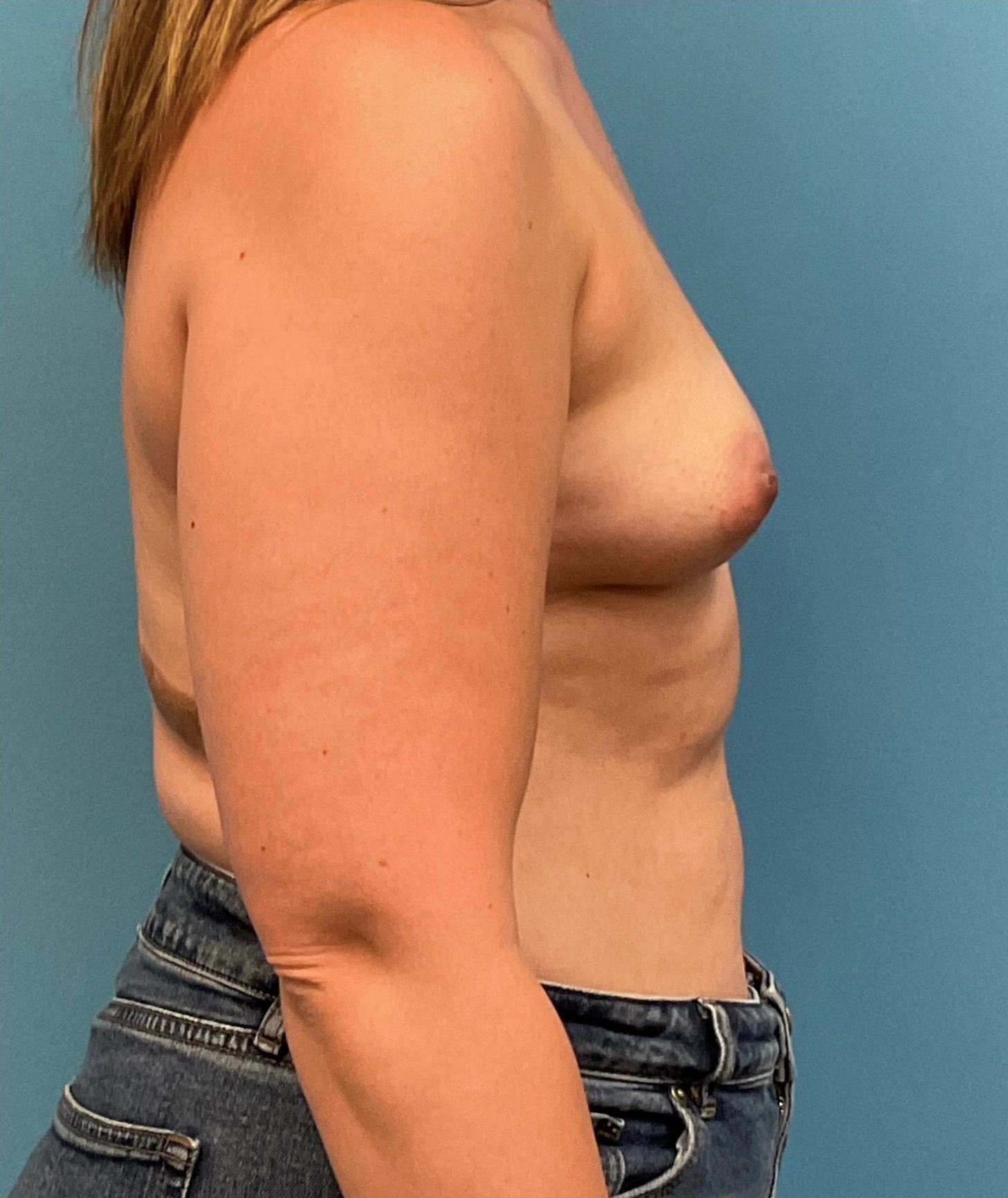 Before Breast Augmentation (Right)