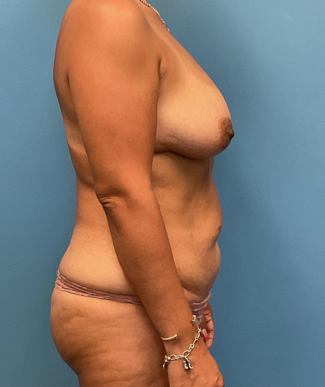 Mommy-Makeover-Case--24090 | Before Mommy Makeover 4