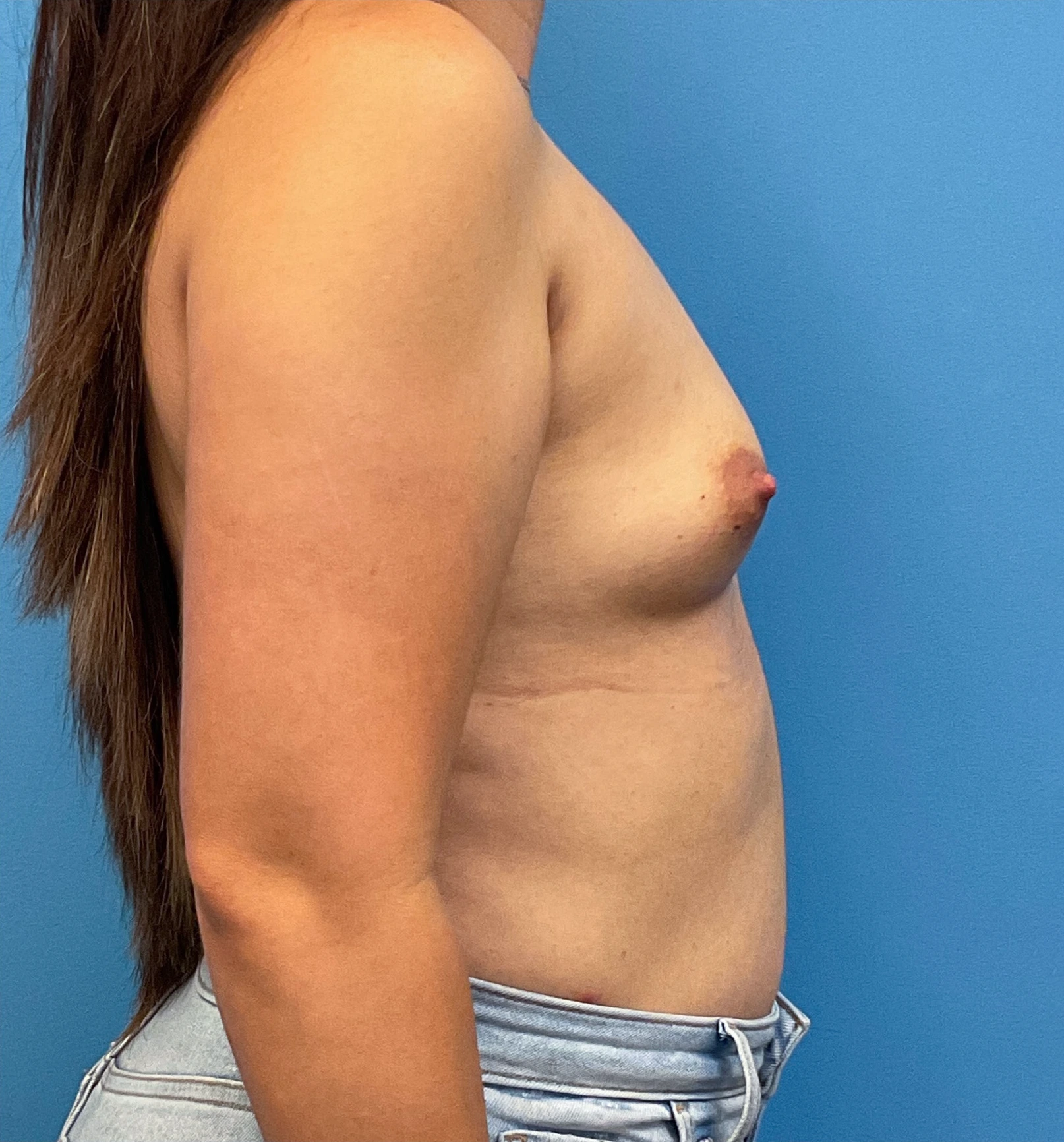 Breast-Augmentation-Case--25743 | Before Breast Augmentation 5