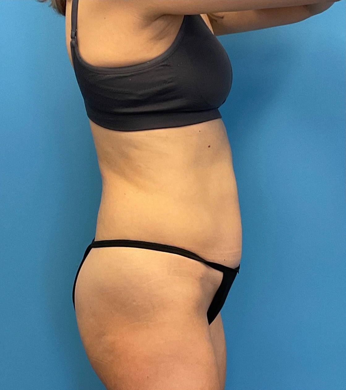 Revision-Tummy-Tuck-Case--23643 | Before Tummy Tuck 5