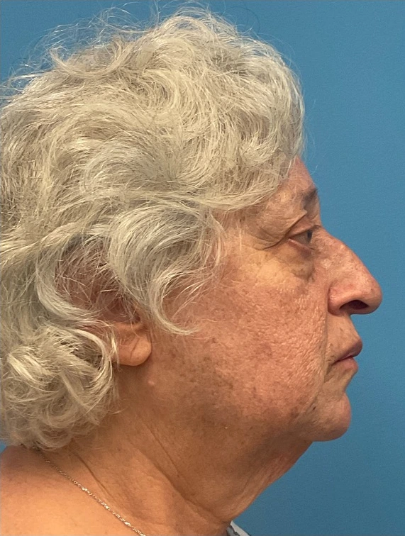 Rhinoplasty-Case--25467 | Before Rhinoplasty 2