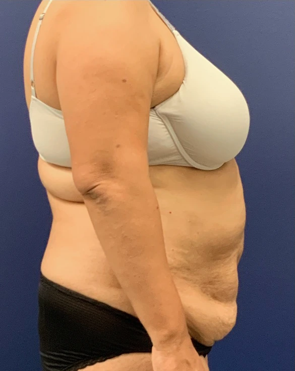 Liposuction-Abdominoplasty-Case--25576 | Before Liposuction 3