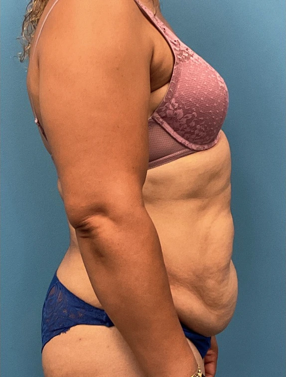 Tummy-Tuck-Case--25988 | Before Tummy Tuck 5