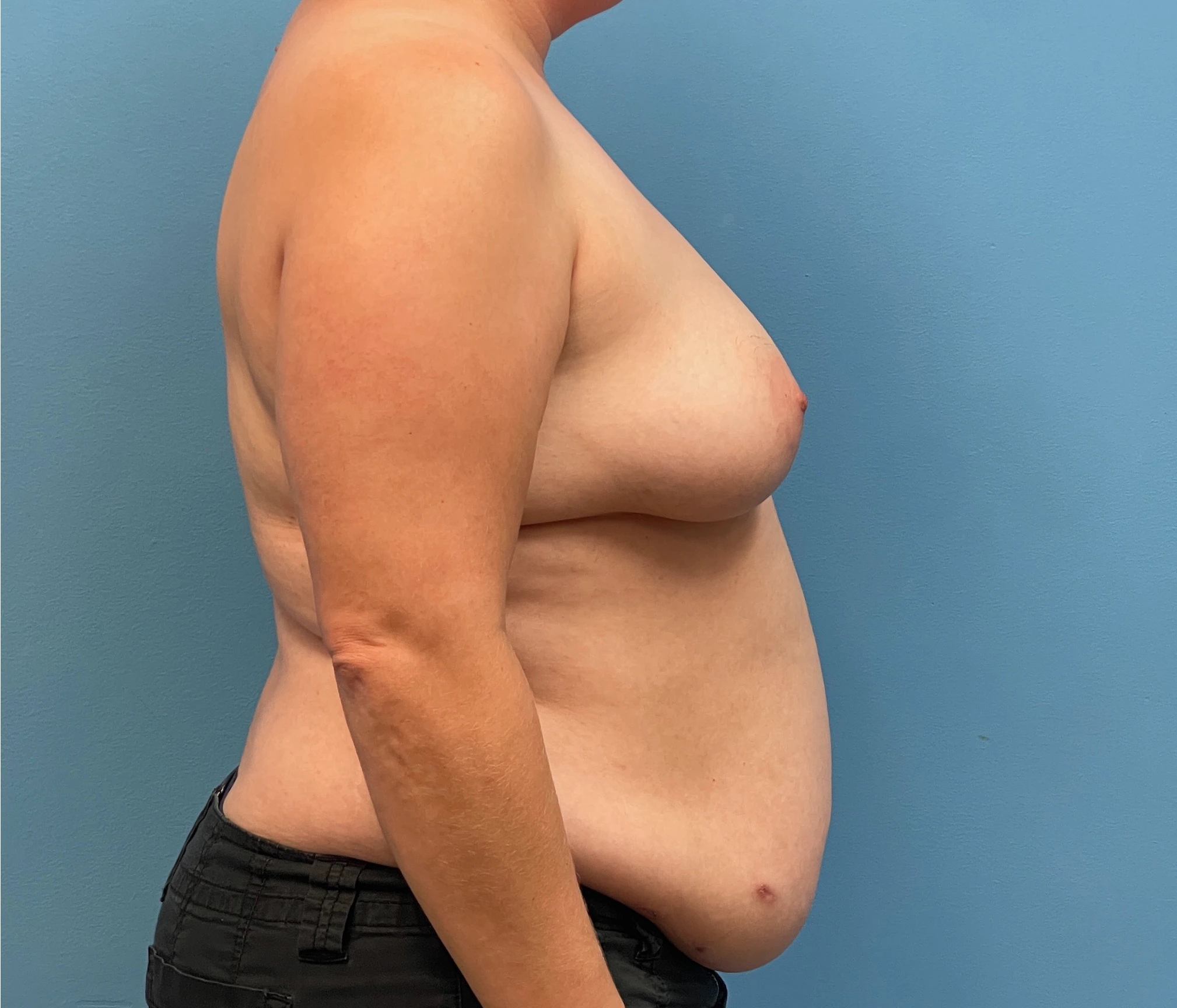 DIEP-Flap-Case--28021 | Before DIEP Flap 3