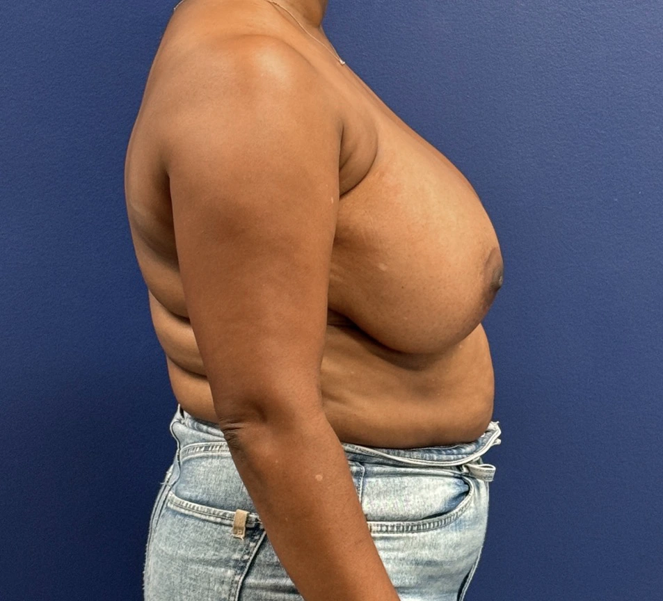 Breast-Reduction-Case--28242 | Before Breast Reduction 3