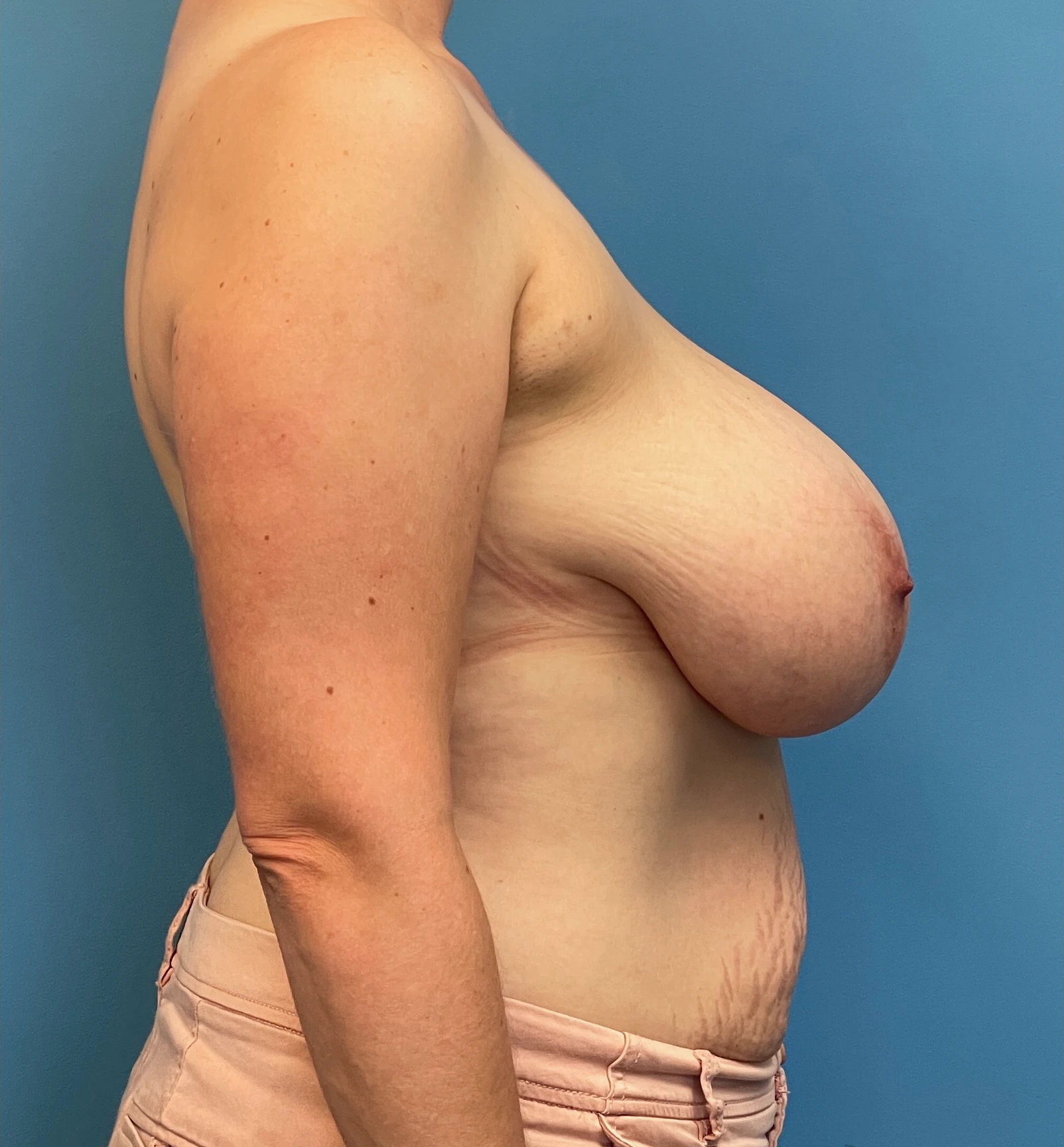 Breast-Reduction-Case--27625 | Before Breast Reduction 3