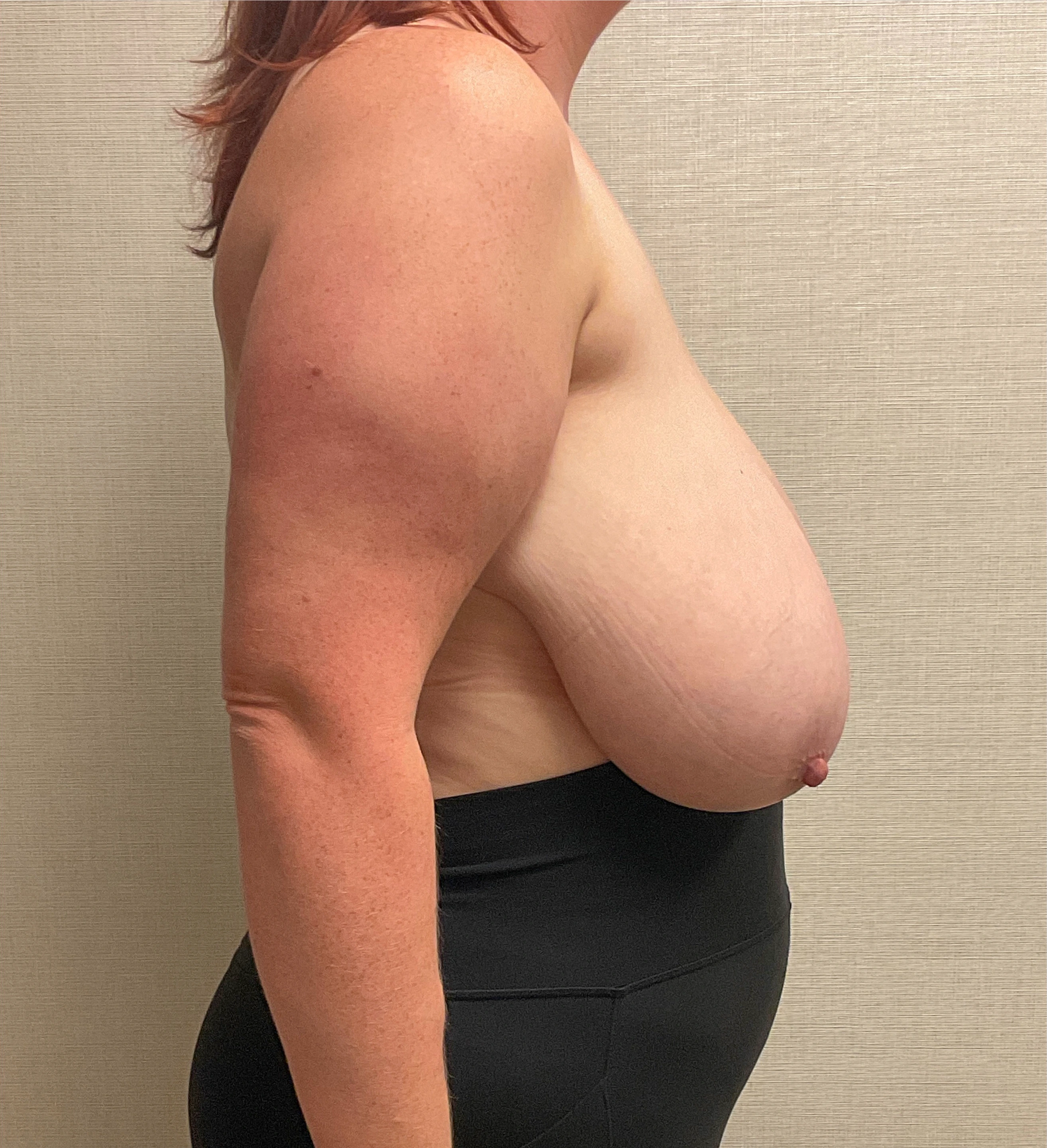 Breast-Reduction-Case--28338 | Before Breast Reduction 3