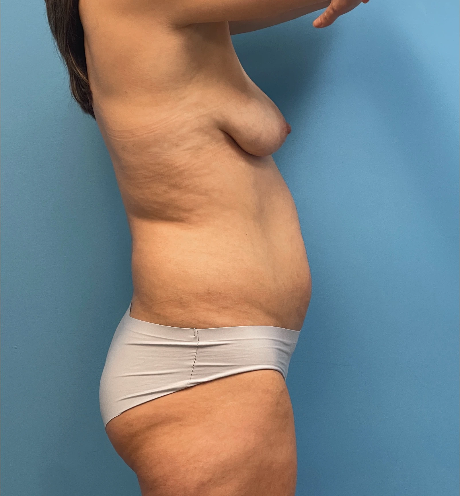Breast-Augmentation-Tummy-Tuck-Case--28080 | Before Body Lift 3