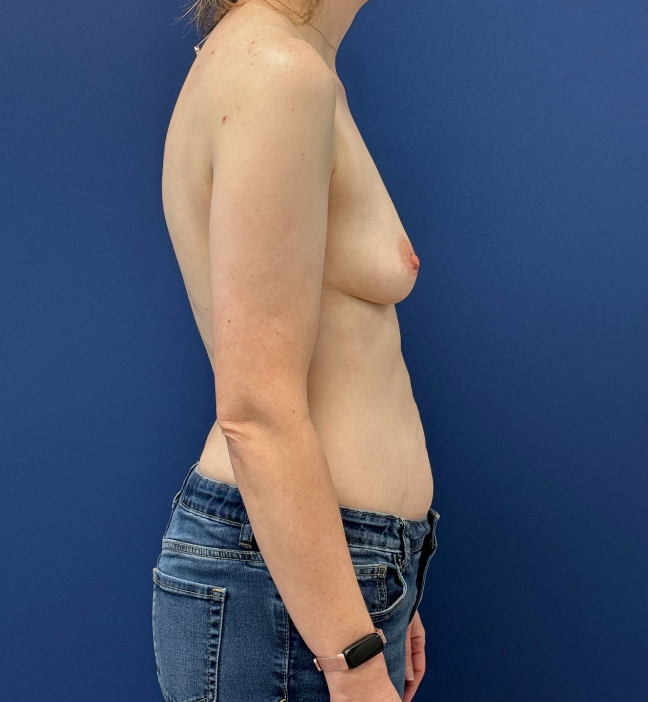 Breast-Augmentation-Case--28670 | Before Breast Augmentation 5