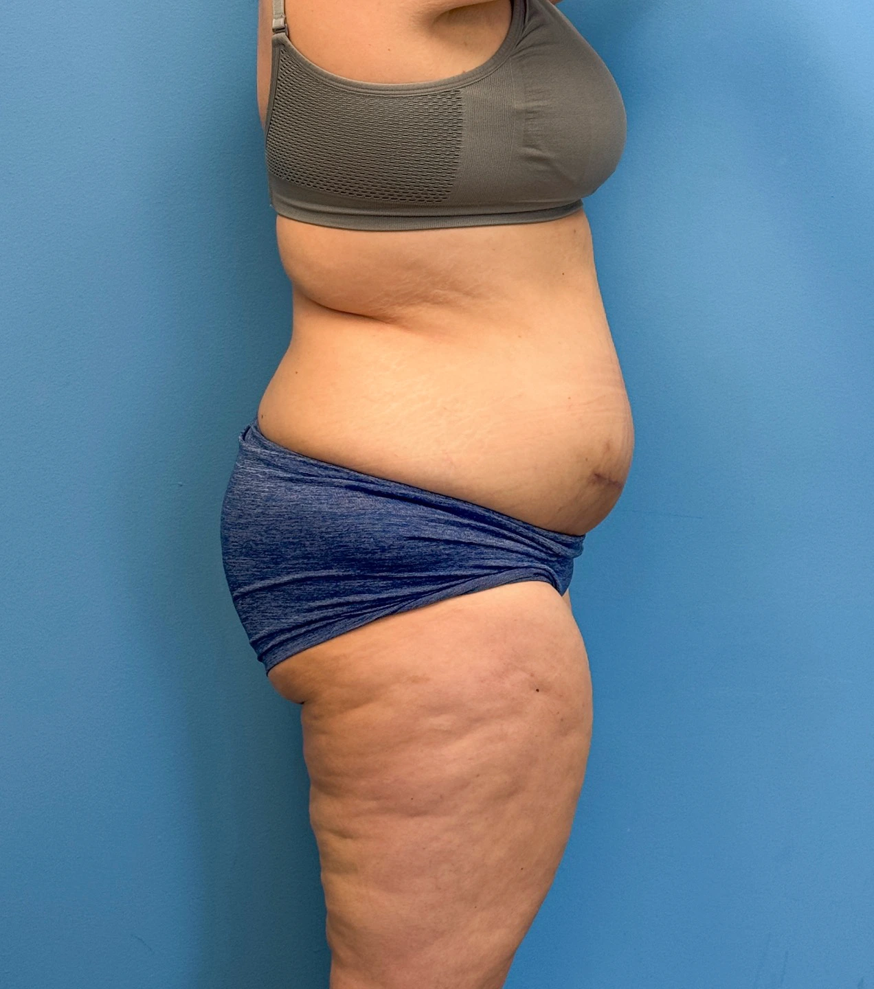 Tummy-Tuck-Case--28426 | Before Tummy Tuck 3