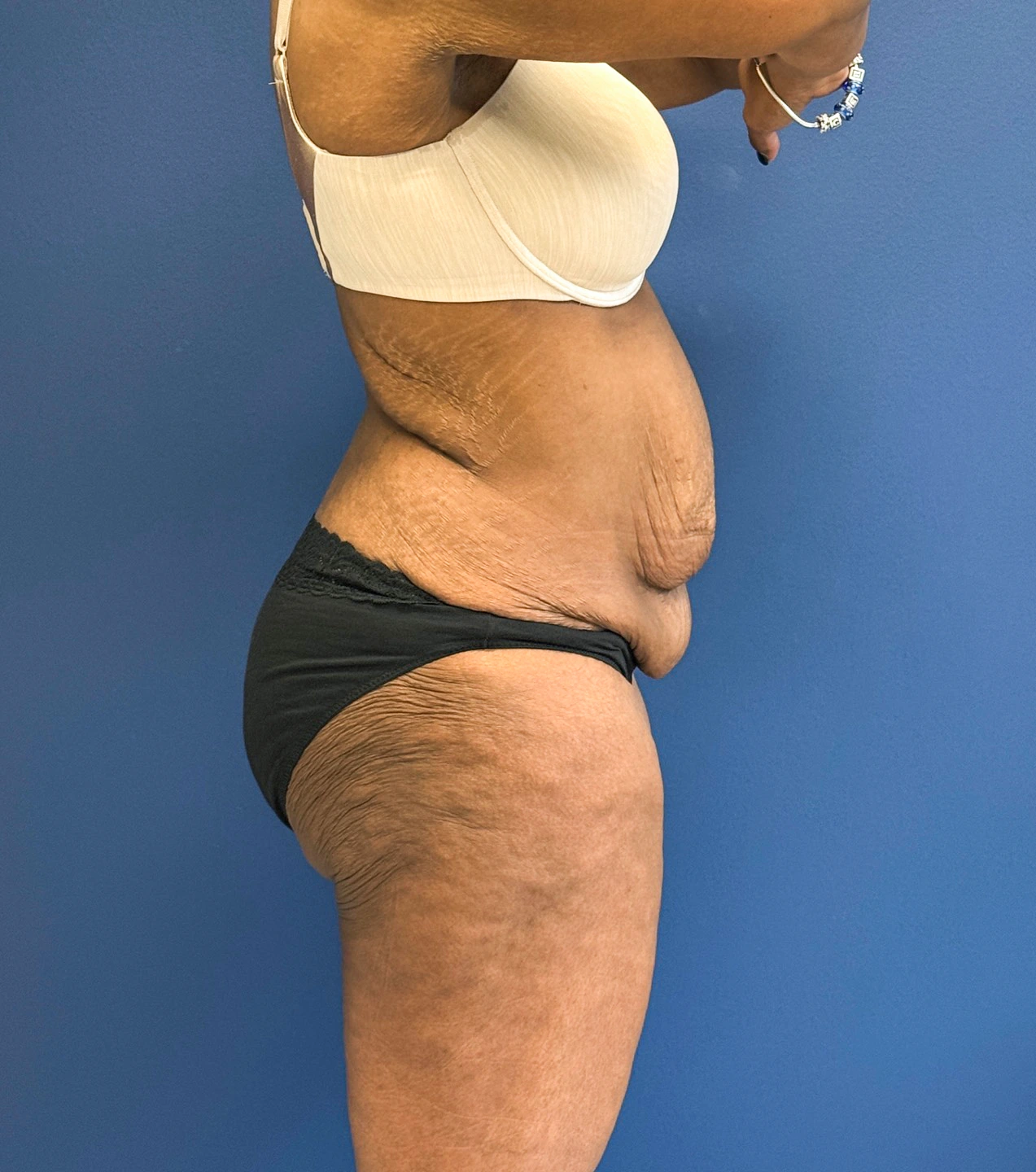 Tummy-Tuck-Case--28714 | Before Tummy Tuck 4