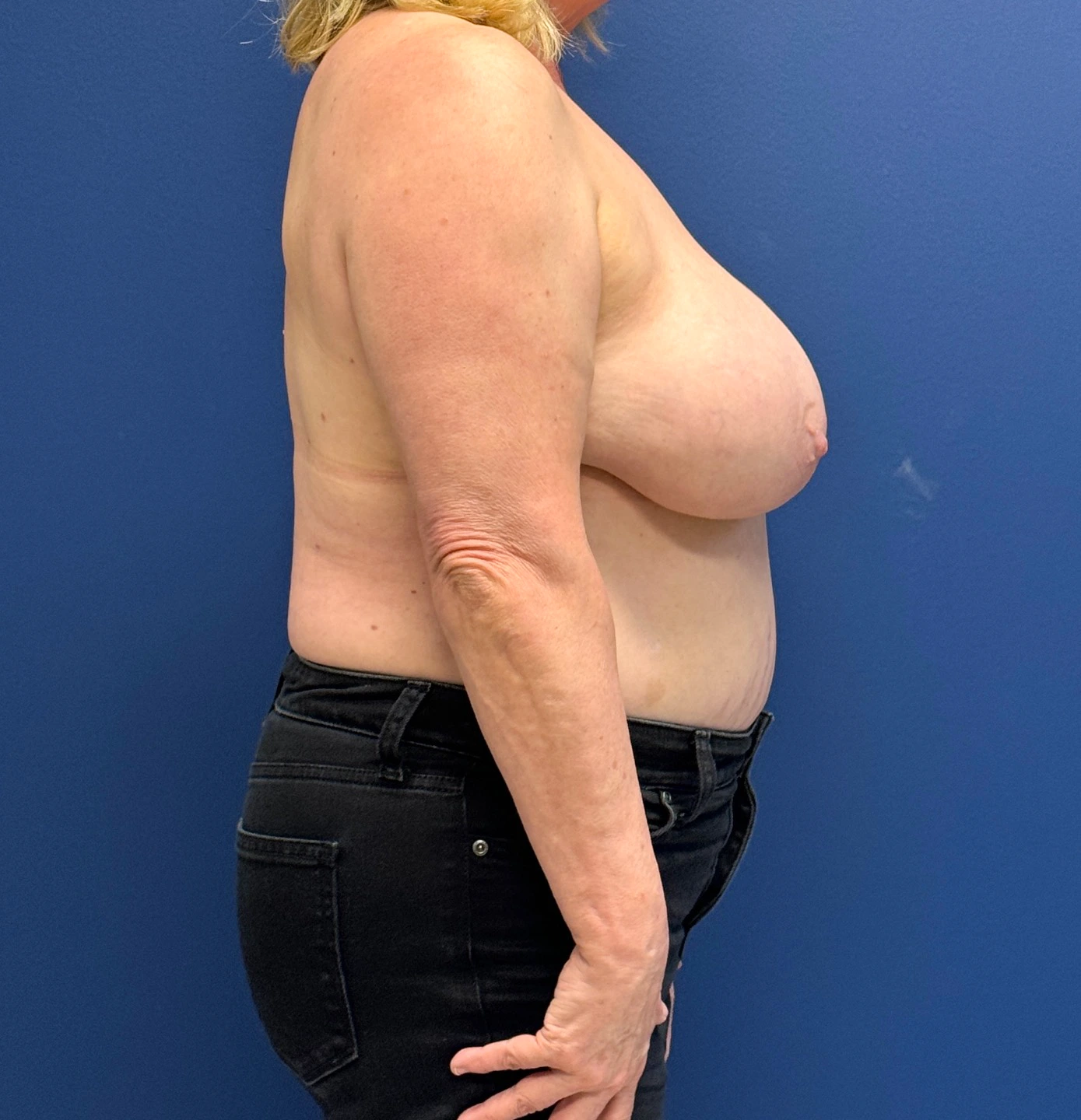 Breast-Reduction-Case--29091 | Before Breast Reduction 3