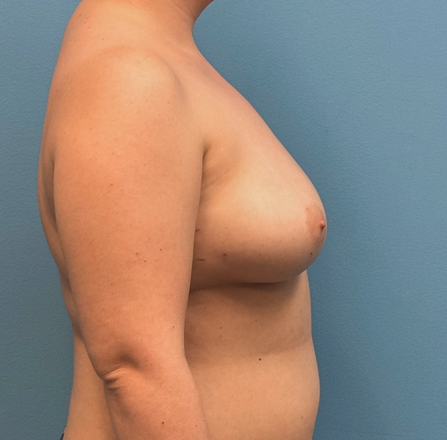 Breast-Reconstruction-Case--28689 | Before Breast Reconstruction 3