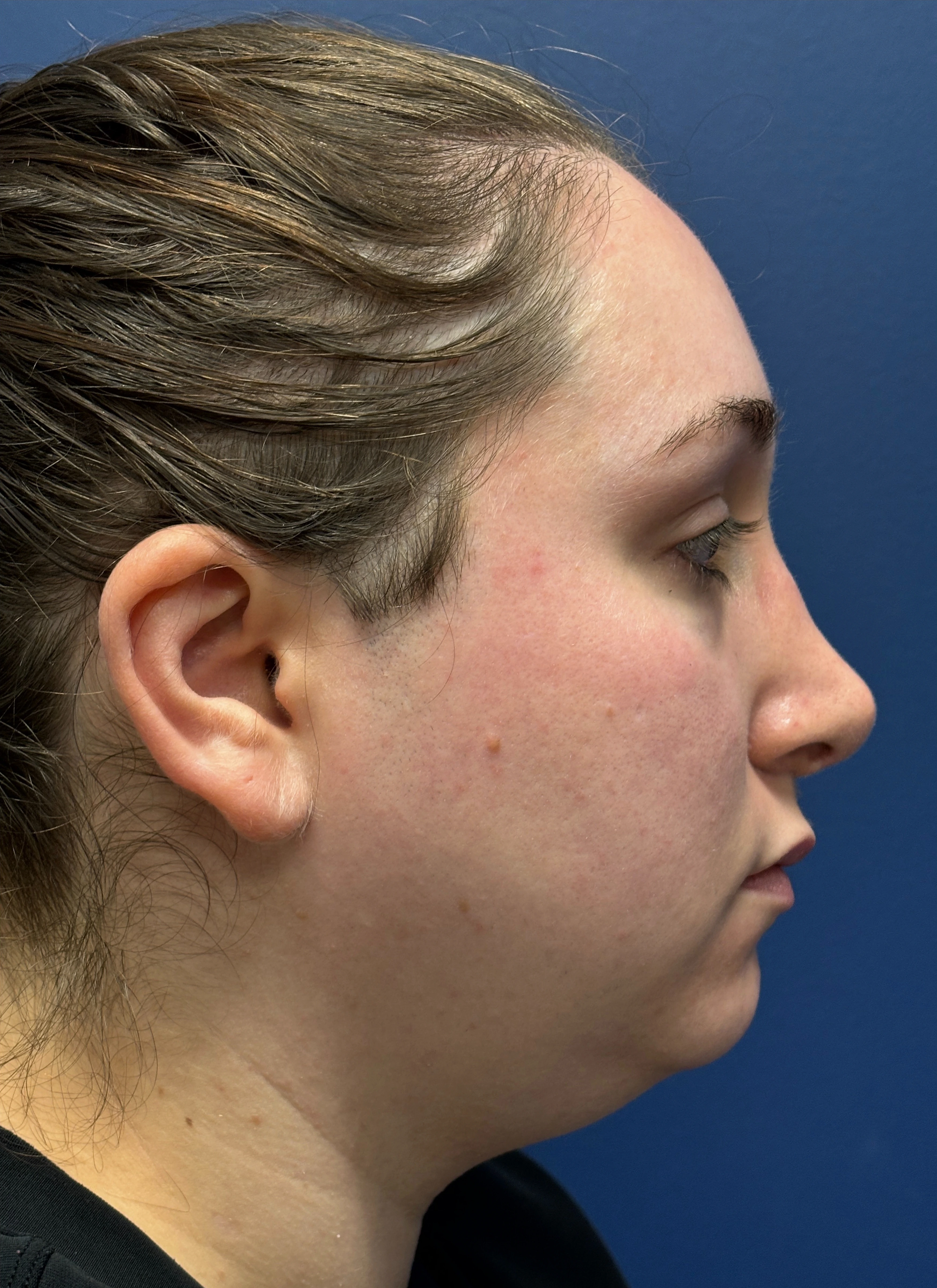 Submental-Liposuction-Case--29107 | Before Submental Liposuction 5