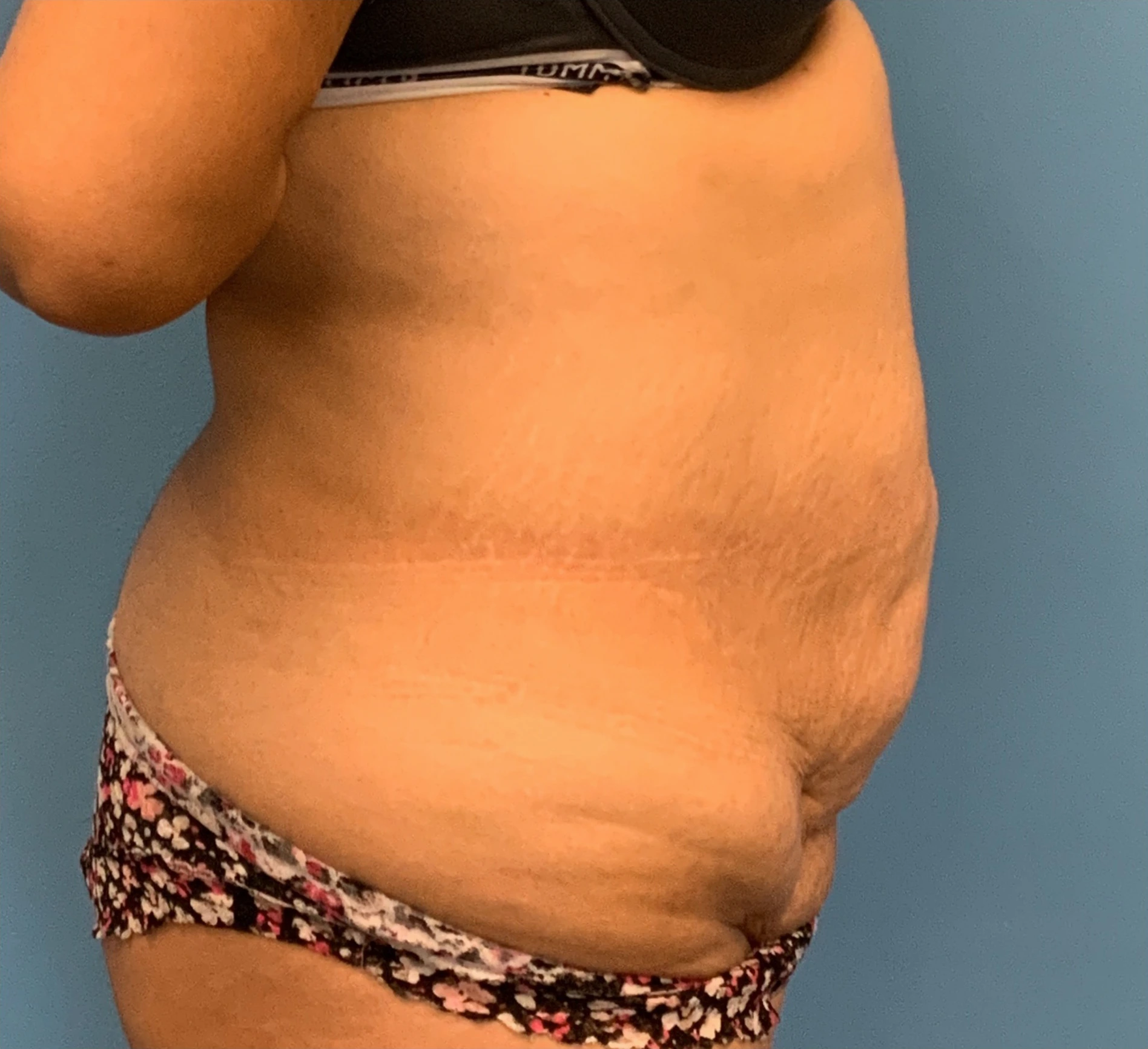 Abdominoplasty-Case--23747 | Before Tummy Tuck 5