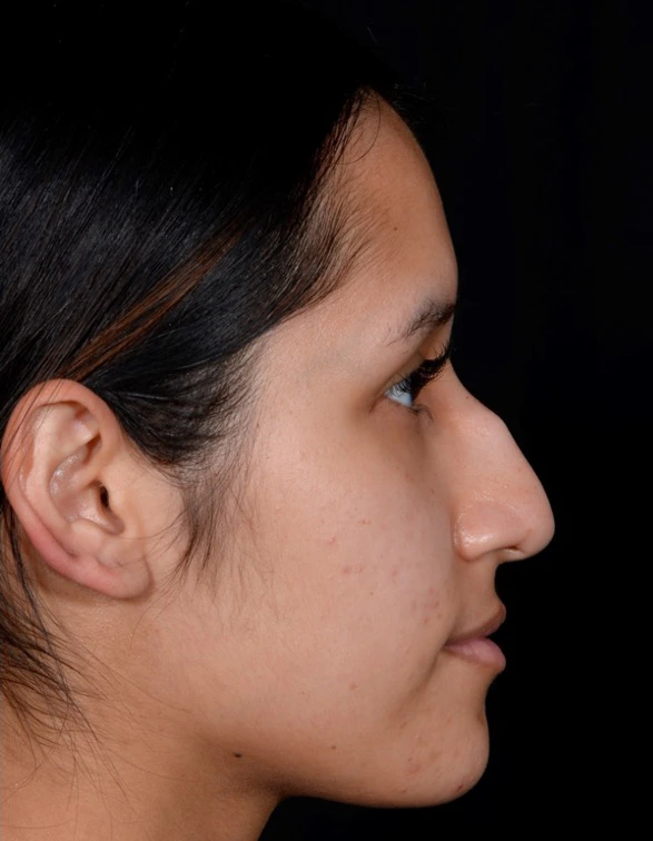 Rhinoplasty-Case--376 | Before Rhinoplasty 3