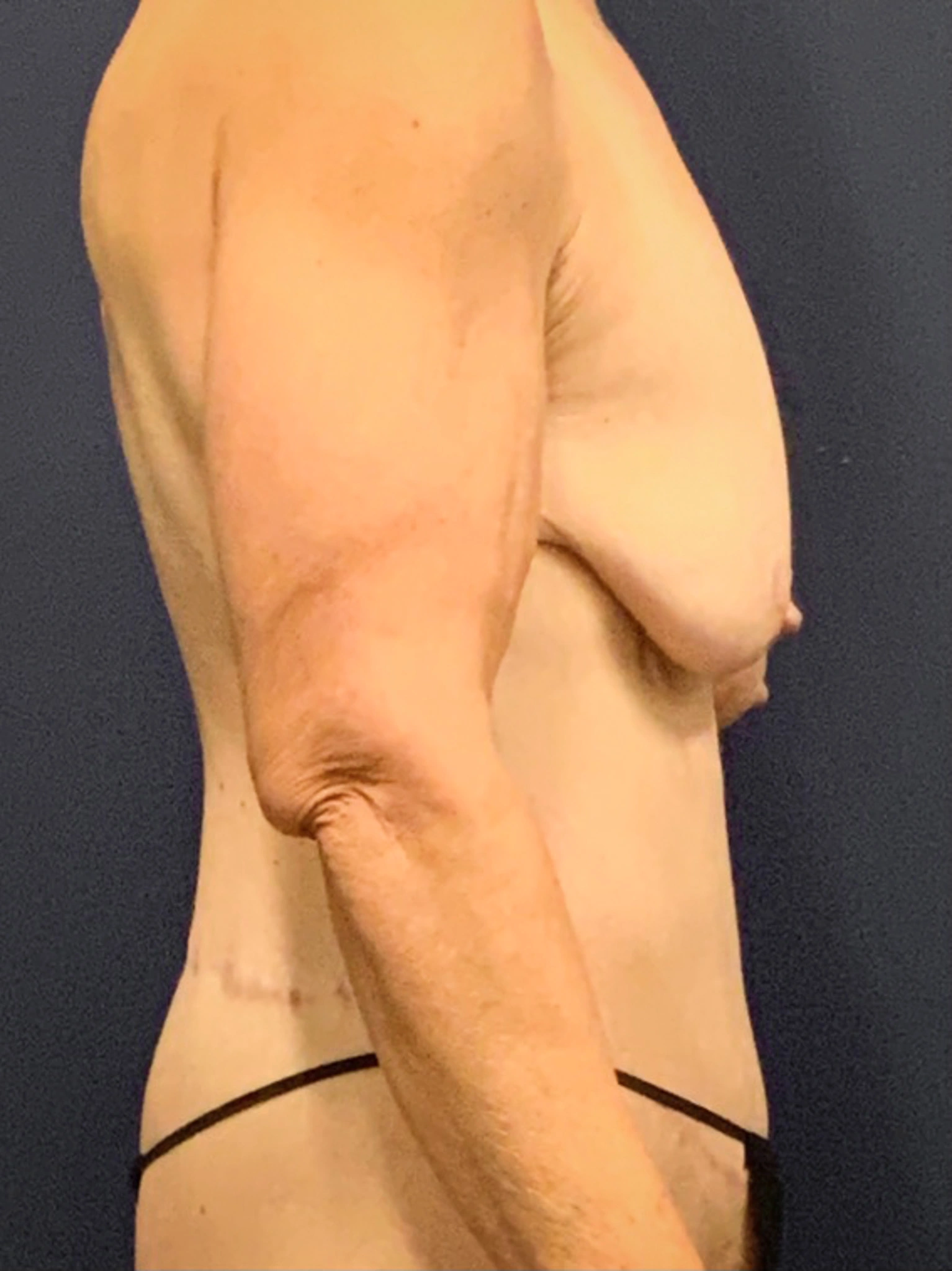 Augmentation-Mastopexy-Case--3055 | Before Breast Augmentation With Lift 3