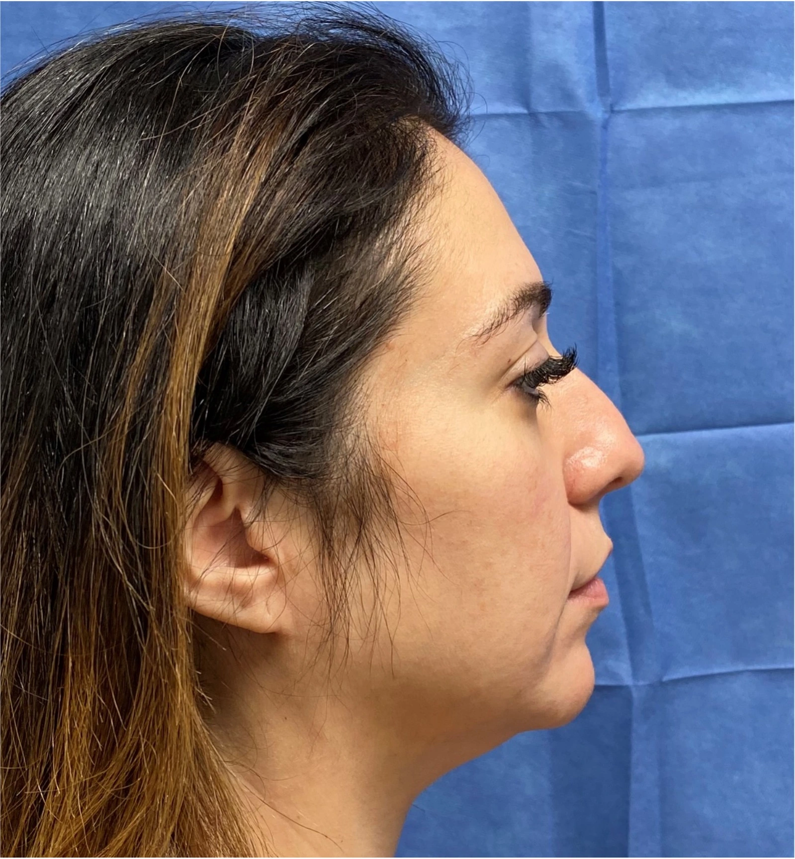 Rhinoplasty-Case--377 | Before Rhinoplasty 3